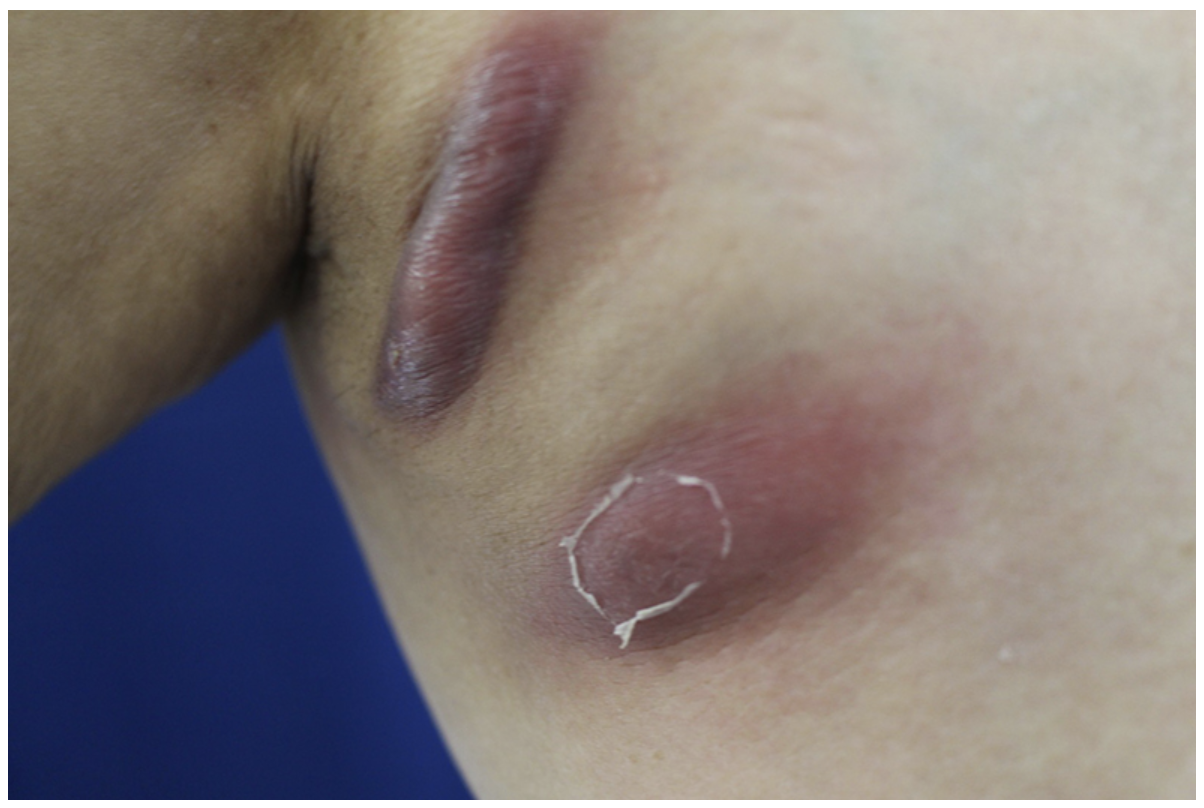 <p>A TB infection of the skin that leads to scrofuloderma, lupus vulgaris (chronic nodules and ulcer)</p>