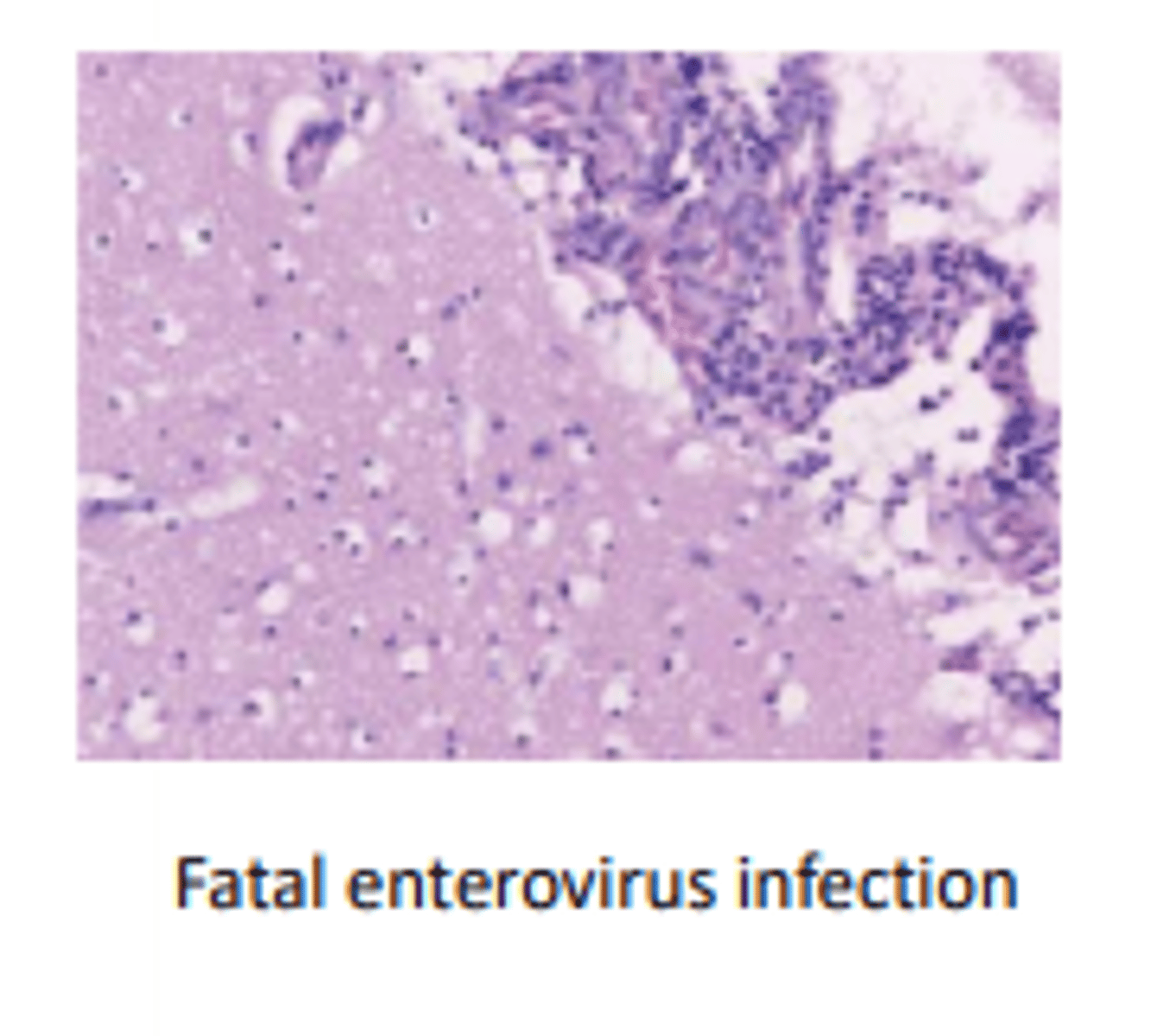 <p>illness characterised by inflammation of meninges, usually with accompanying mononuclear pleocytosis ( increased mononuclear cell count; normal CSF contains 0-5MNC). not caused by pyogenic bacteria</p><p>- viral infection is most common cause of aseptic meningitis; enteroviruses are most common viral cause</p><p>- there are also noninfectious cases of aseptic meningitis, however, term is alsmost synonymoys w viral meningitis</p><p>symptoms: headache, fever, some cases can be severe and life threatning</p>
