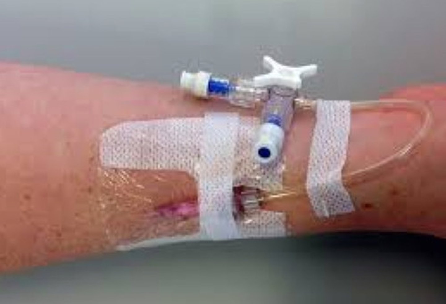 <p>used to deliver intravenous fluids or medications</p><p>(commonly: dorsal hand, wrist; cubital fossa; dorsal foot)</p>