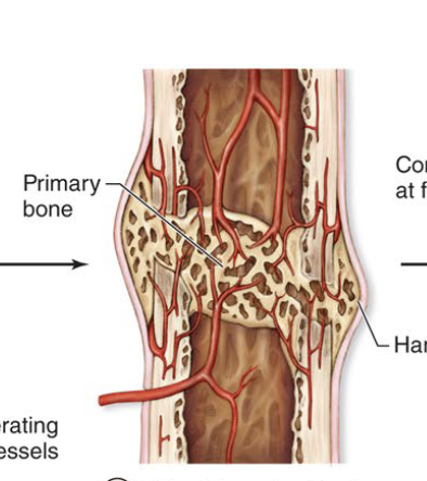 <ul><li><p><strong><u>Third step to fracture repair (several months)</u></strong></p></li><li><p><strong><u>Soft callus replace with spongy bone</u></strong></p></li></ul><p></p>