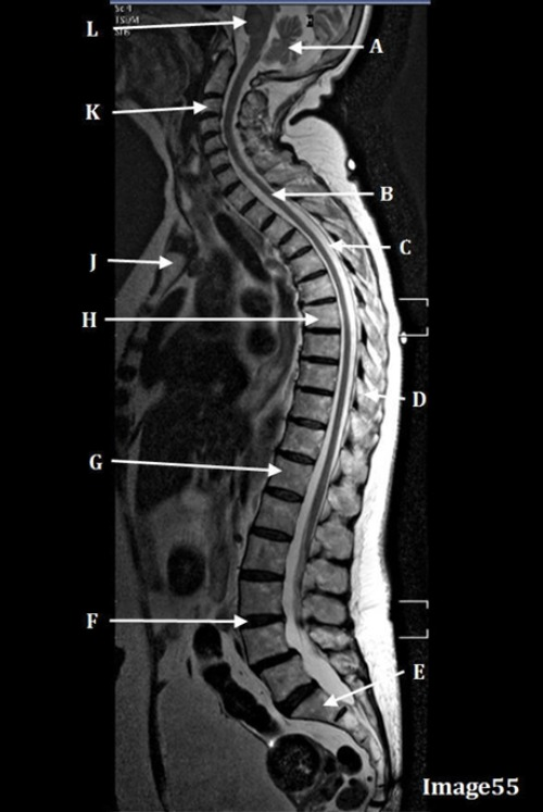<p>Letter C in Image 55 is pointing to:</p><p>A. Medulla oblongata</p><p>B. Spinal cord</p><p>C. Cerebrospinal fluid (CSF)</p><p>D. Spinous process</p><p>E. Cerebellum</p>
