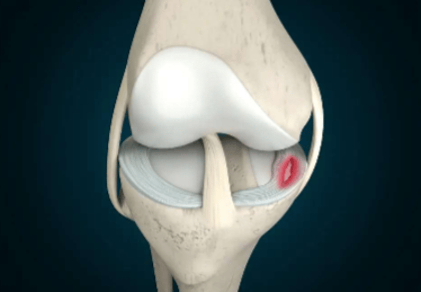 <p>fibrocartilage, slow healing</p>