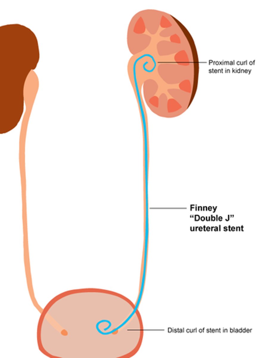 <p>Double-J or pigtail stent</p>