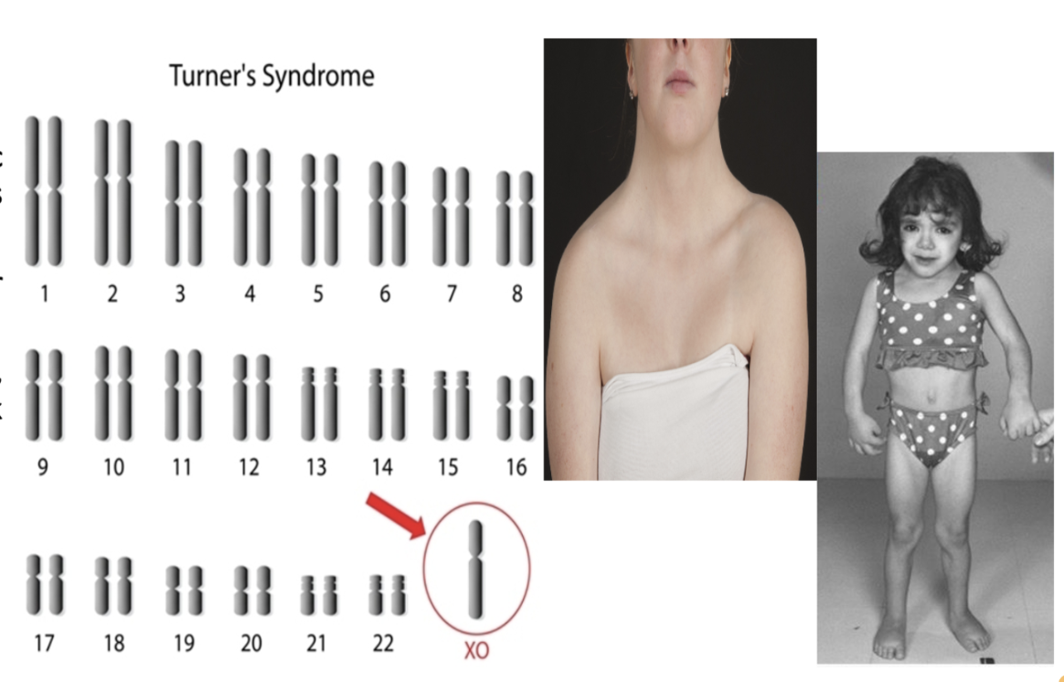 <p>Turner Syndrome (XO)</p>