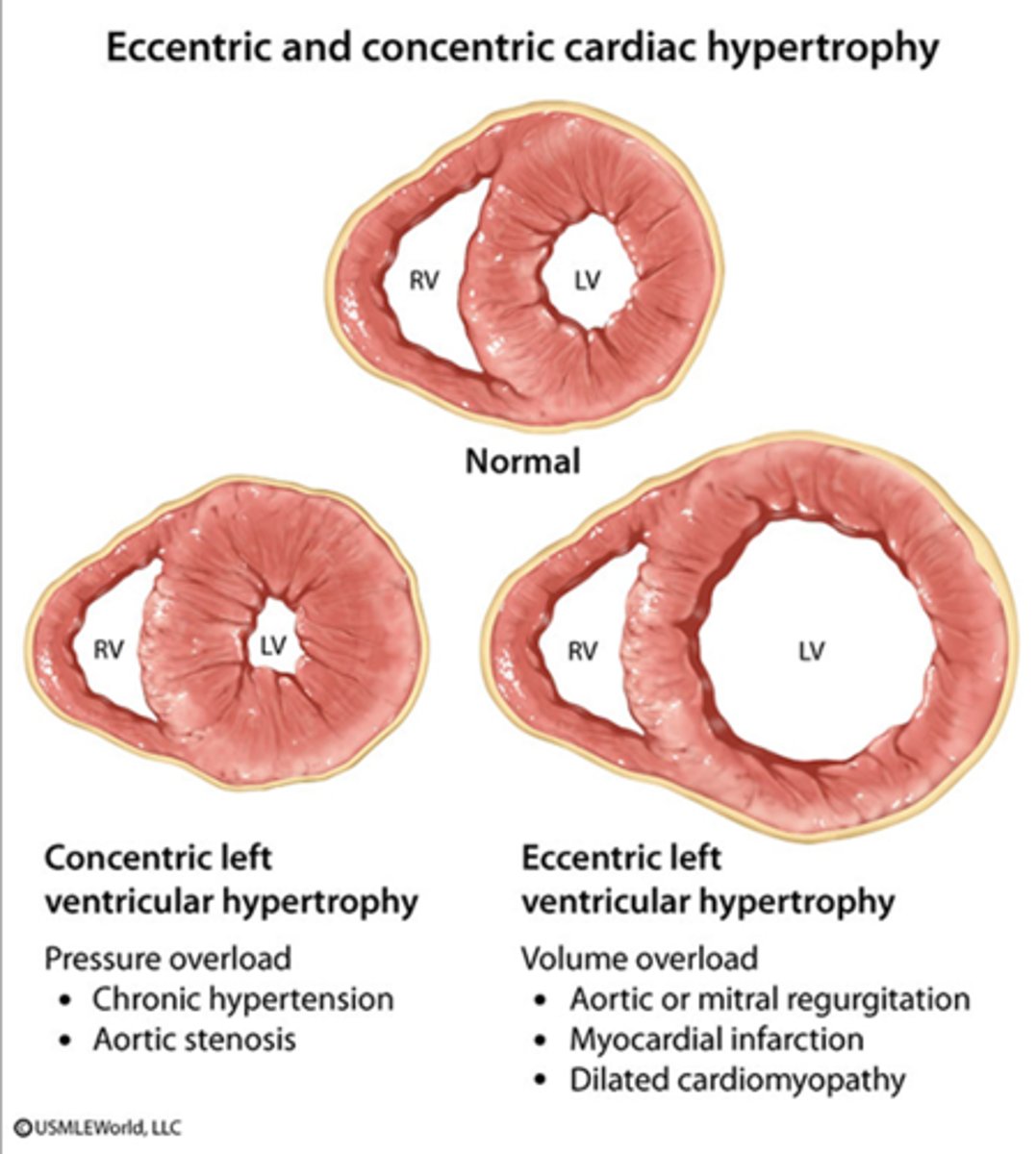 <p>muscle enlargement from overuse</p>