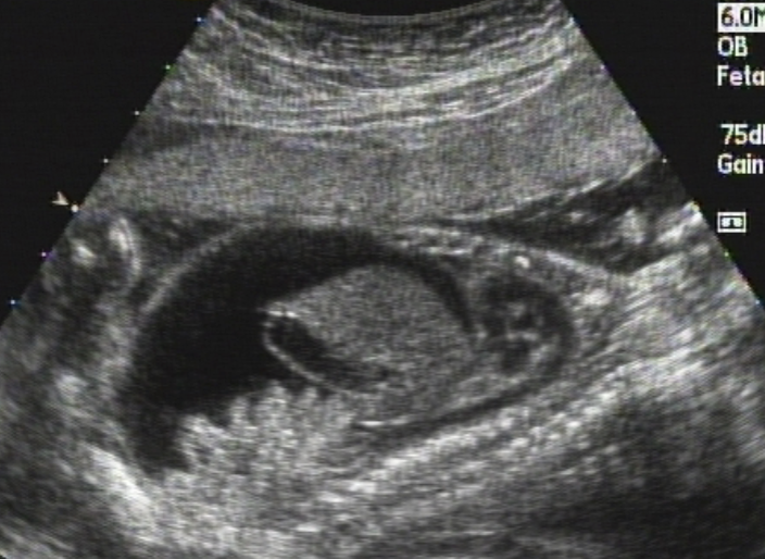<ul><li><p>fluid in the peritoneum</p></li><li><p>ALWAYS abnormal</p></li><li><p>commonly seen w/ <u>hydrops</u> but can be isolated</p></li></ul><p></p>