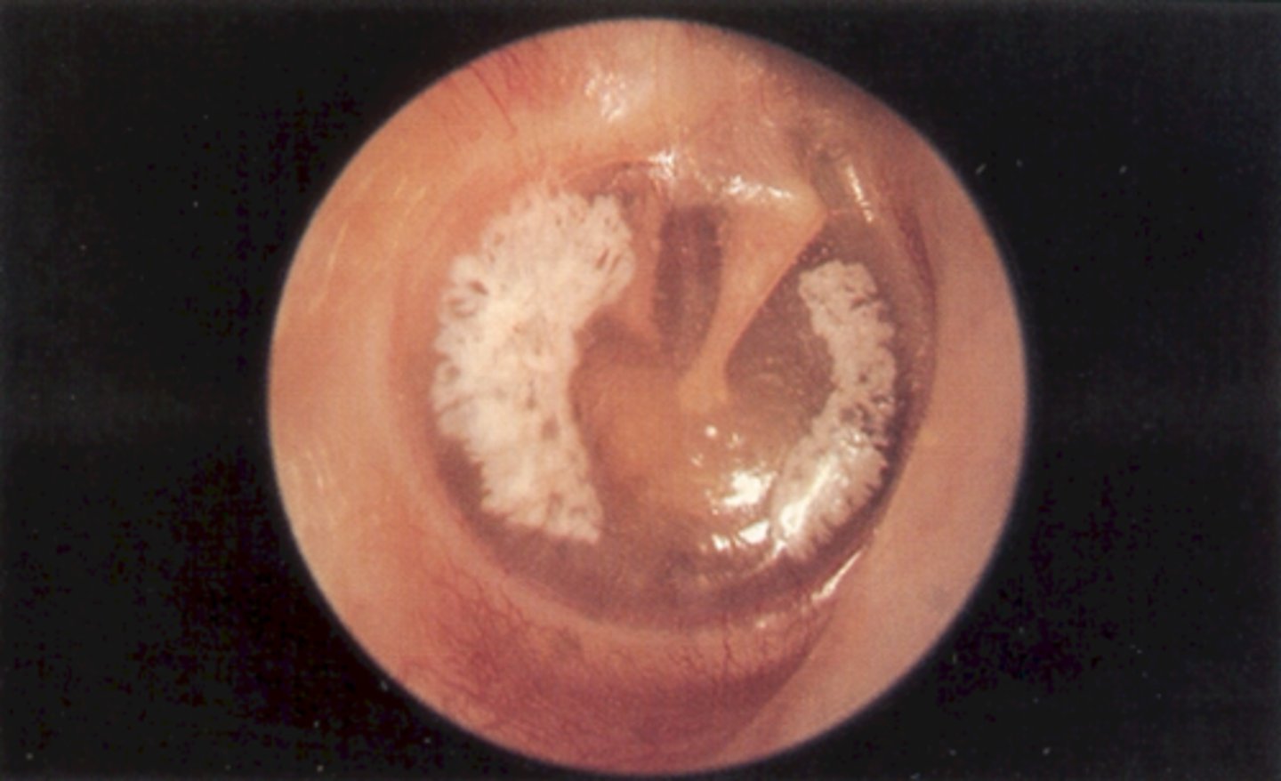 <p>Deposition of hyaline material in TM layers - follows perforated TM</p><p>"Hyalinization"</p><p>Large, chalky, white patches with irregular margins</p><p>Usually doesn't impair hearing</p>