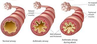 <ul><li><p>A chronic, reactive airway disorder → episodes of airway obstruction with bronchospasm, mucus secretion and mucosal swelling</p></li><li><p>Hen suyễn</p></li></ul>