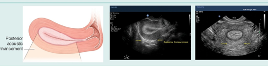 <p>what uterine phase is this (endometrial thickness)?</p>