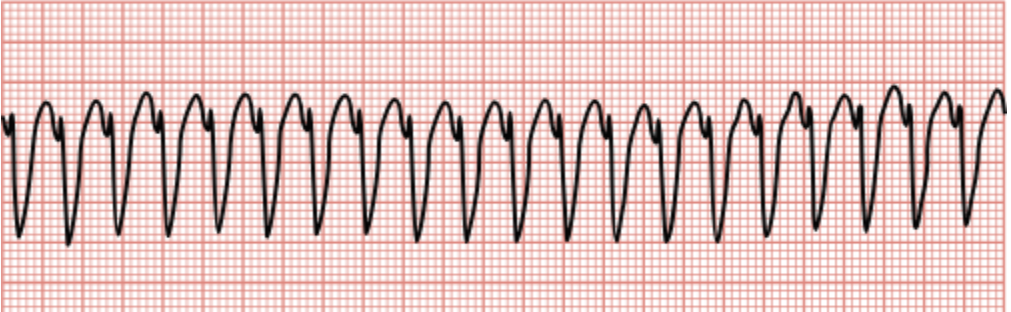 <p>Regular, fast rhythm characterized by large, irregular, wide QRS complexes, often without visible P waves.</p>
