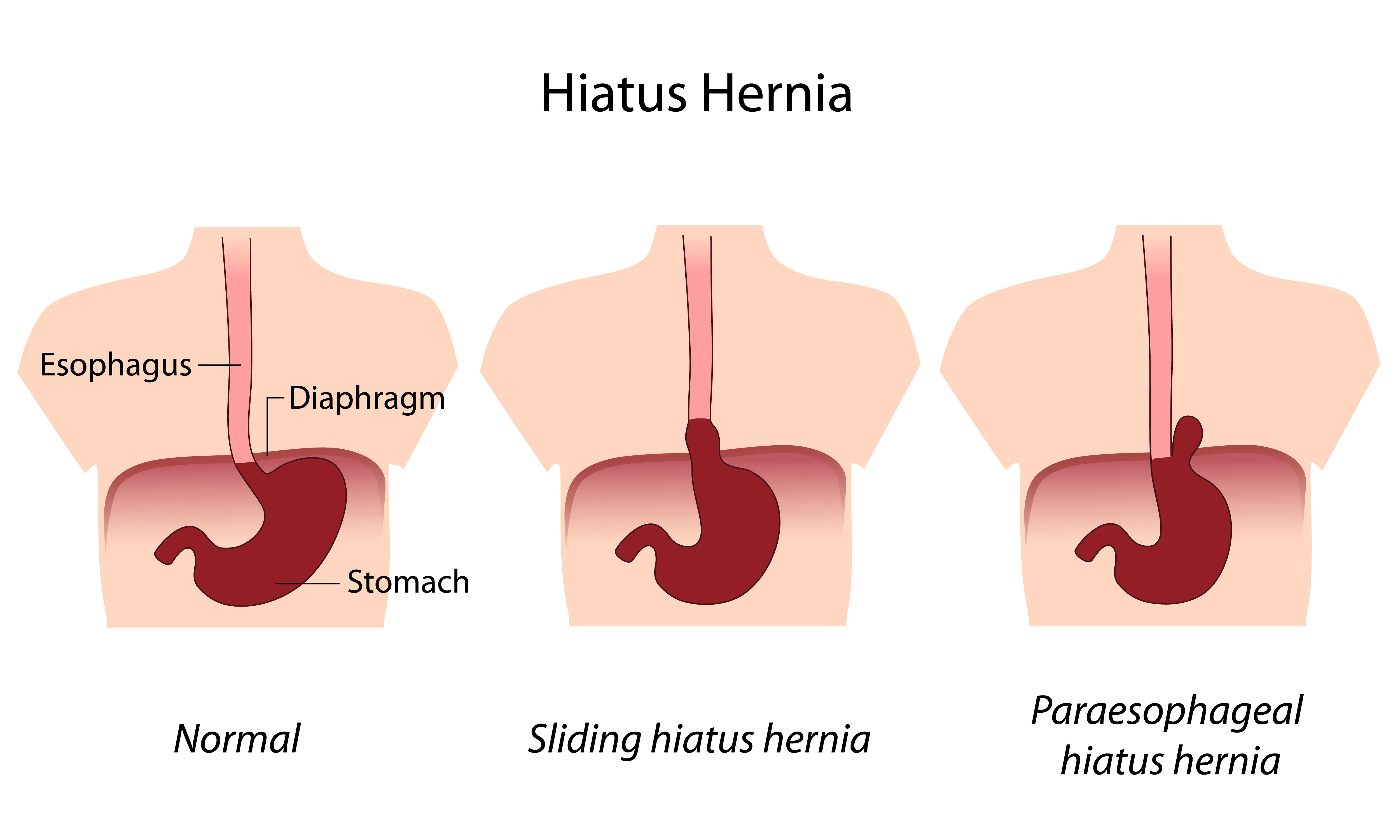 <p>What is the difference between a <strong>paraesophageal </strong>and a <strong>sliding hiatal hernia?</strong></p>