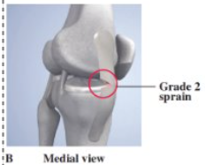 <p>- complete tear of deep ligament, partial tear of superficial layer<br><br>- slight swelling, laxity at 30 degrees of flexion, joint tightness, decreased ROM<br><br>- tx: POLICE (48-72 hrs), crutches, brace/casts, gradual progression to closed kinetic chain exercises</p>