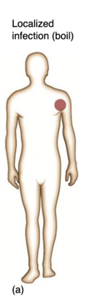 <p>microbes enter the body and remains confined to a specific tissue</p>