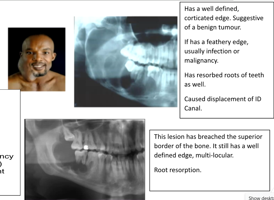 <p>1) Often Asymptomatic</p><p>2) Bucco-Lingual Expansion - degree of facial swelling</p><p>3) Root Resorption or Displacement</p><p>4) Commonly Multi-locular but can be Uni-locular on Radiographs</p>