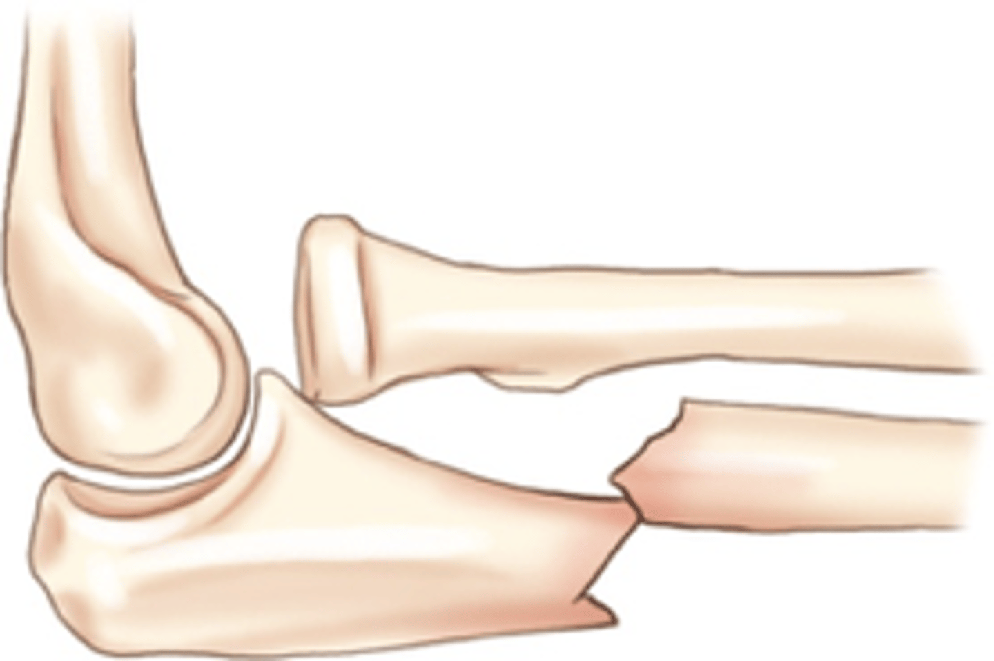 <p>Proximal ulna along with dislocation of radial head</p>