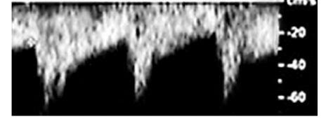<p>Reversed flow, so theres collateral circulation. there would be a delayed systolic acceleration and an increased diastolic flow to compensate for the lack of flow in the CCA.</p>