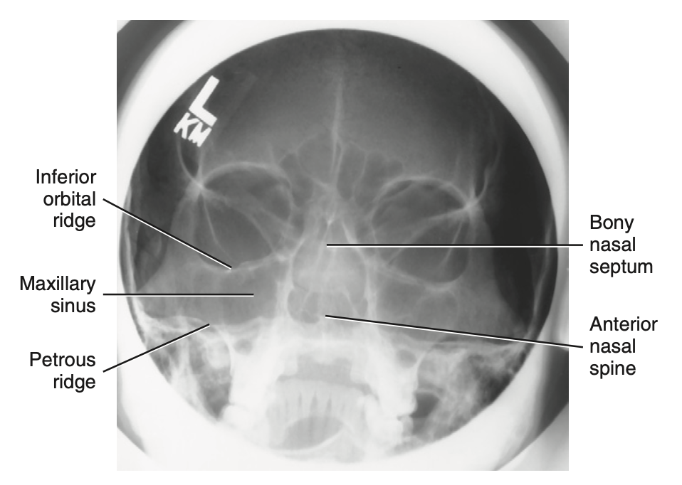 <p>Special: How do you <u>critique</u> radiograph of <strong>Modified Parietocanthial projection: Modified waters method </strong>for <strong>facial bone</strong>?</p>