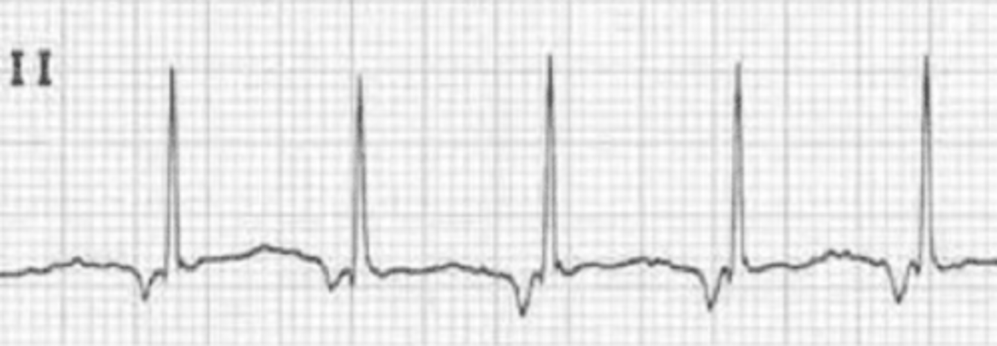 <p>-regular</p><p>-rate: 100-150bpm</p><p>-P Wave: NONE or INVERTED </p><p>-PR Interval: None or &lt;0.12 </p><p>-QRS: &lt;0.12 sec</p>