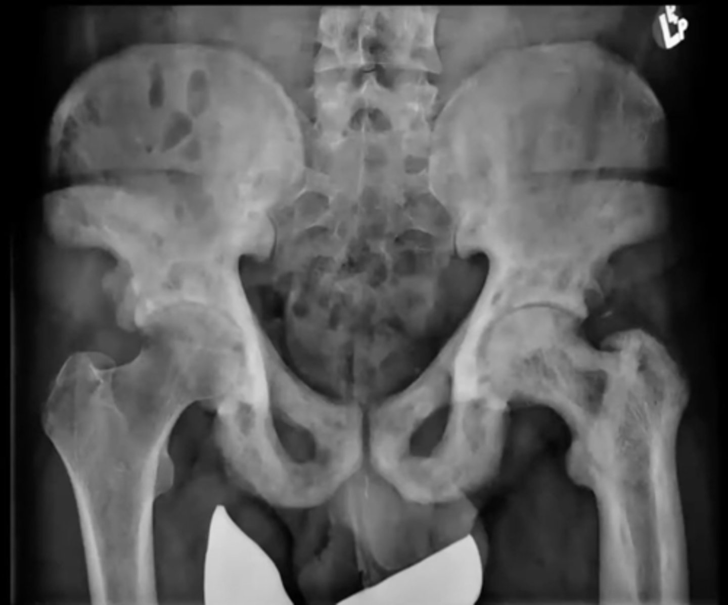 <p>What is this?</p><p>Ex. Elderly man with b/l hip pain</p>