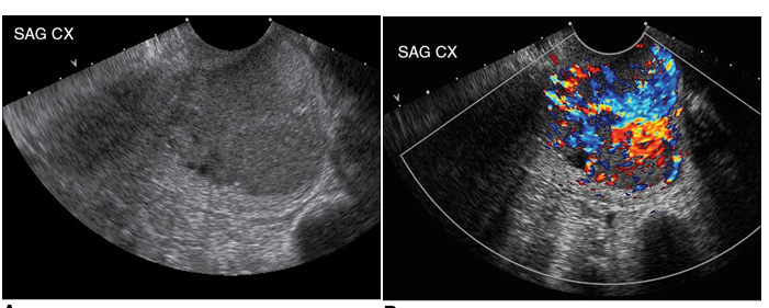 <p><strong><mark data-color="yellow" style="background-color: yellow; color: inherit;"><u>Mc cervical malignancy</u></mark></strong></p><ul><li><p>vaginal discharge/bleeding</p></li></ul><p></p>