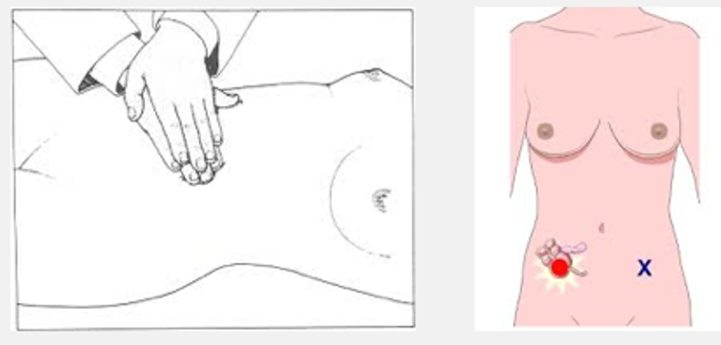 <p>Pain in R LQ /c application of pressure to L LQ; indicative of appendicitis.</p>