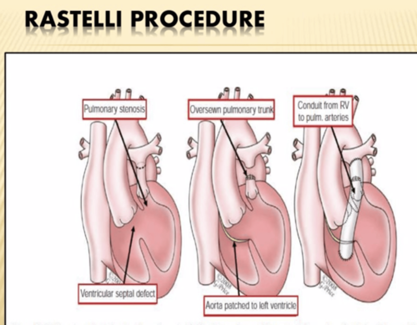 <p>Correction of transposition of great arteries</p><p>Aorta is rerouted internally to LV across VSD and pulmonary artery is attached to RV externally.</p><p>RV hypoplasia is contraindication bc conduit from LV to aorta goes through VSD into already small RV.</p>