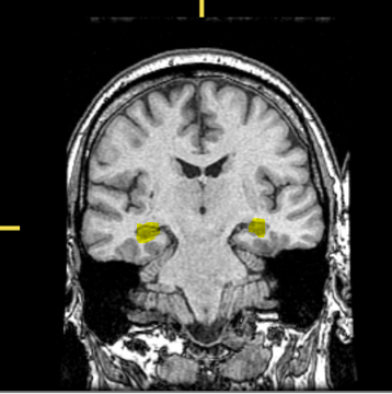 <p>What part of the brain is highlighted?</p>