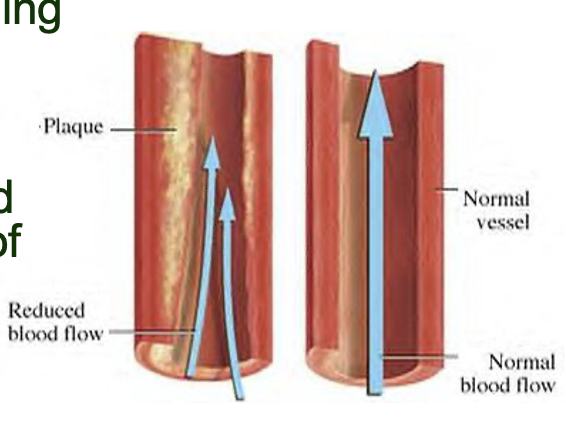 artherosclerosis

\
cholesterol in atherosclerosis