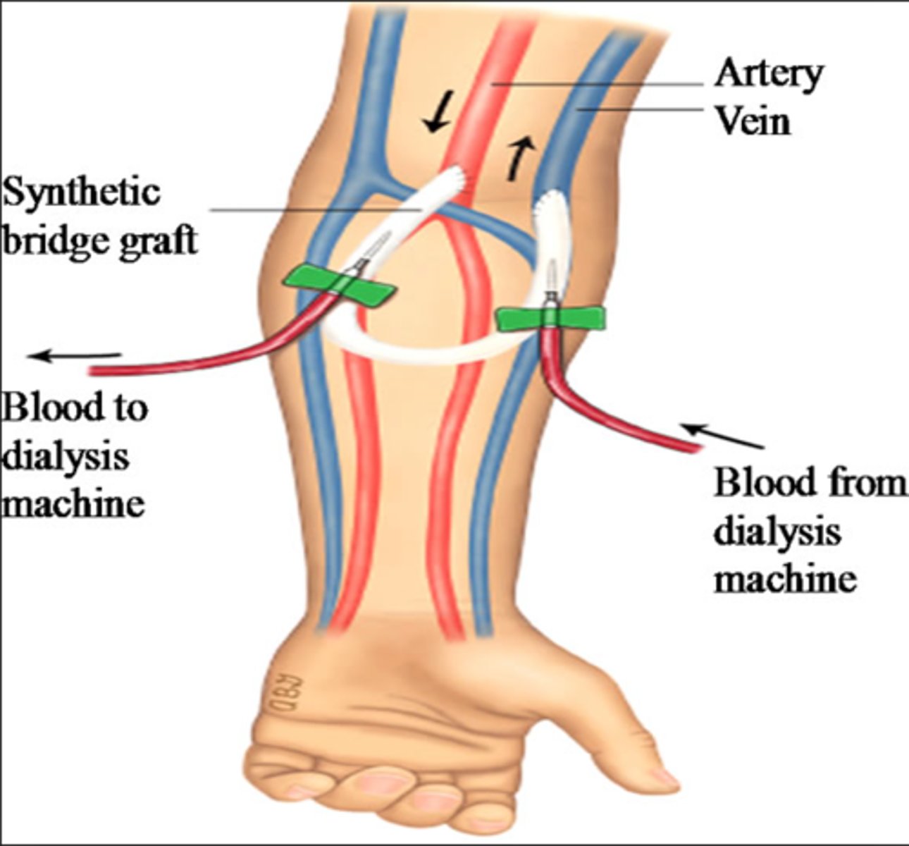 <p><strong><u>a piece of artificial vessel created as an access; one end is connected to an artery and the other to a vein</u></strong></p><p><em>Limitations:</em><br>- shorter lifespan (&lt;5 years)<br>- HIGH thrombosis rate<br>- HIGH infection rate</p><p><em>Advantages:</em><br>-short maturation period (2 weeks)<br>-easier cannulation</p>