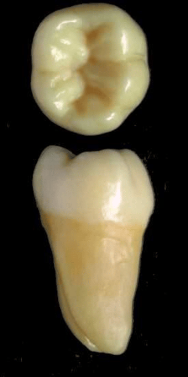 <p>what tooth is this &amp; why?</p>