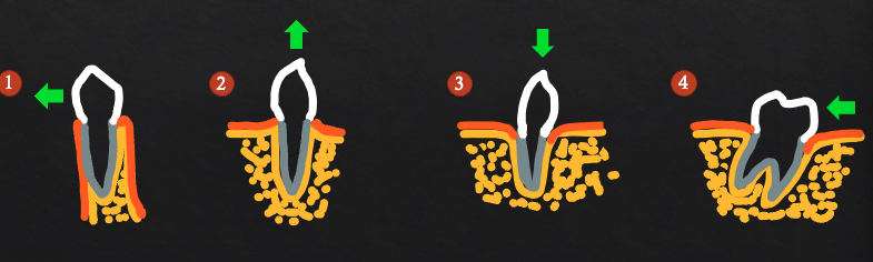 <p>creates bony defects (dehiscence)</p>