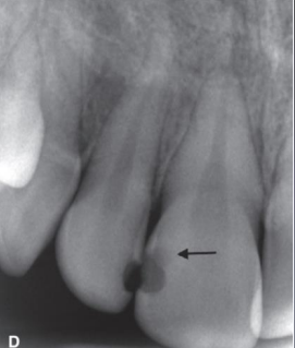 <p>composite will be well-defined, caries are more diffused </p>