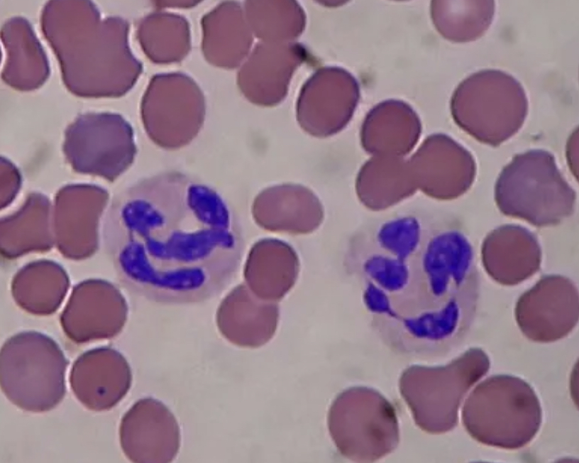 <p>the nucleus looks like a chain of sausages “thick-thin-thick-thin” </p><ul><li><p>no 2 of these look exactly alike </p></li><li><p>somethings the thin area of the sausage might not stain so the sausage looks detached </p><ul><li><p>dont confuse with monocyte… look at the thickness of nucleus sausage </p></li></ul></li></ul><p></p>