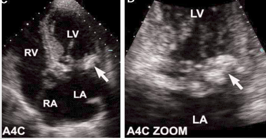 <p>severe MAC&nbsp;</p><ul><li><p>wonder if patient has fever or other signs of infection&nbsp;</p></li></ul><p>fibroelastoma</p><p>lambl’s excrescences</p><p></p>