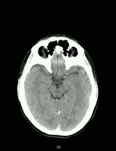 <p>What Part of Brain Stem?</p>