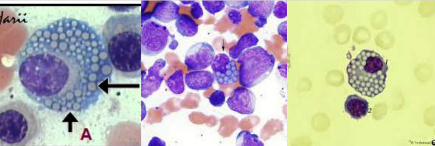 <p>A. Identify the abnormality / cell</p><p>B. This is seen in what condition / disease</p>