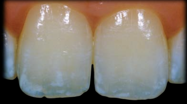 <ul><li><p>Type IV Opalescent Layer presents mixed opalescence patterns (1, 2, or 3) associated with some kind of pigmentation or characterization.</p></li><li><p>25% of patients exhibit Type IV Opalescent Layer.</p></li></ul><p>*White spots, white cloudy pigmentation, or amber staining can be observed on Type IV Opalescence Layer.</p>