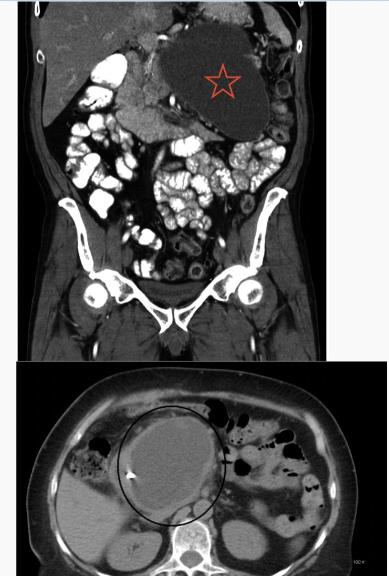 <p>Pancreatic Pseudocyst</p>