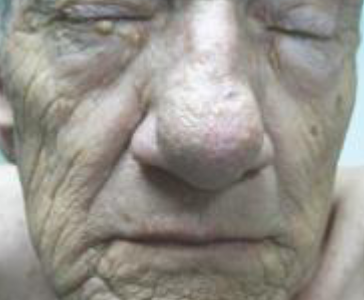 <p>start at an earlier age on sun damaged skin</p>