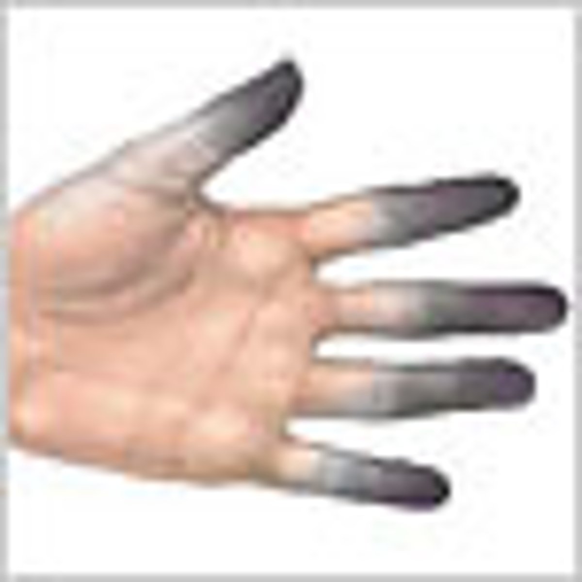 <p>skin looks white, gray or blue; numbness; severe pain when warmth is returned to area</p>
