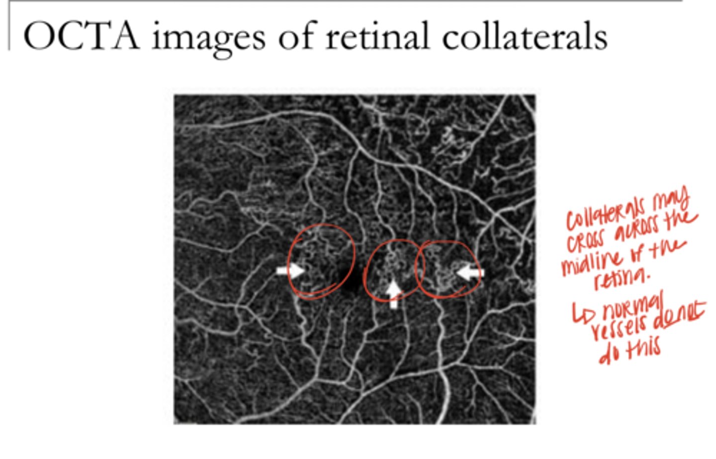 <p>Do normal retinal vessels cross the midline?</p>