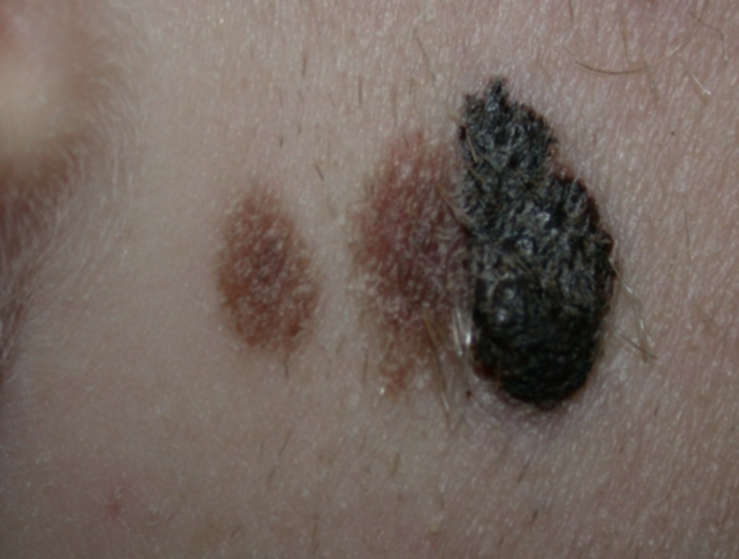 <p>a lesion that appears to be on it's own from another lesion</p>