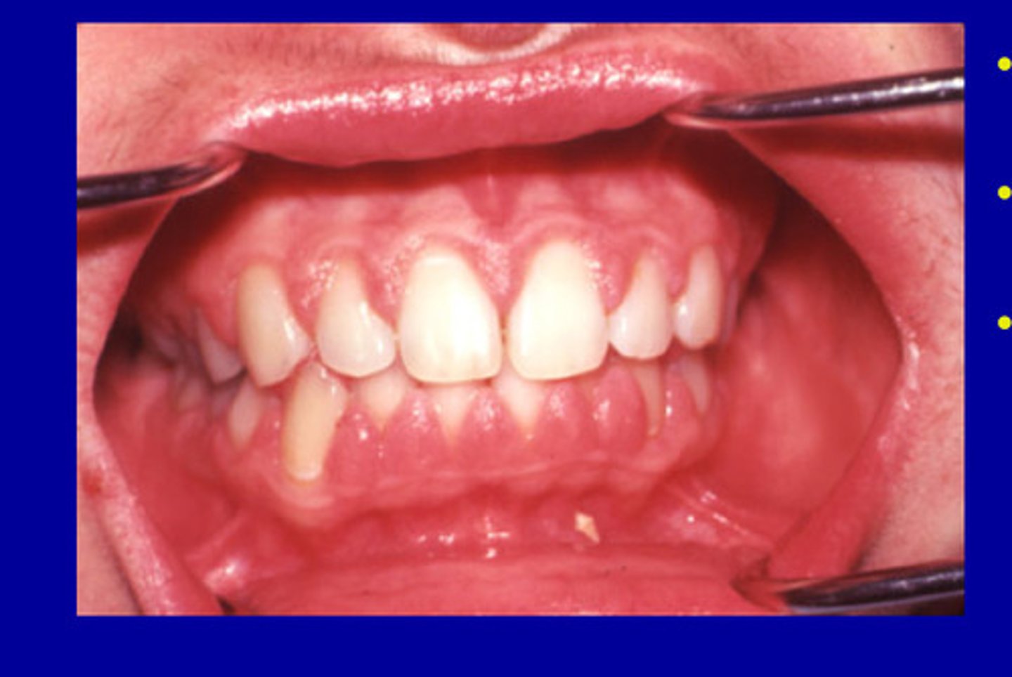 <p>• enlargement occurs in about 50% of patients</p><p>• genetic predisposition suspected</p>