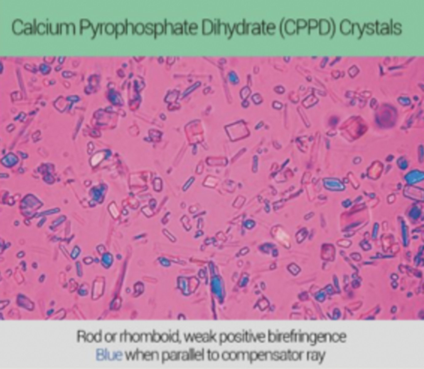 <p>- Calcium crystals</p><p>- Positive bifringement, PSEUDOGOUT</p><p>- Blue when parallel to compensator ray</p>