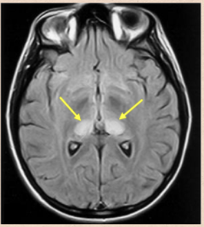 <ul><li><p><span style="color: yellow"><strong>Immunologic assessment + EEG + MRI</strong></span></p><ul><li><p><span>Confirm by brain biopsy - NOT recommended</span></p></li><li><p><span>Post-mortem is preferred</span></p></li><li><p><span>Detection of protein kinase inhibitor (14-3-3)</span></p></li><li><p><span><strong><u>EEG</u></strong>: starts with periodic activity; then periodic spikes alternating with slow periods</span></p></li><li><p><span><strong><u>MRI</u></strong>: symmetric or unilateral hyperintense signals from basal ganglia</span></p></li></ul></li></ul><p></p>