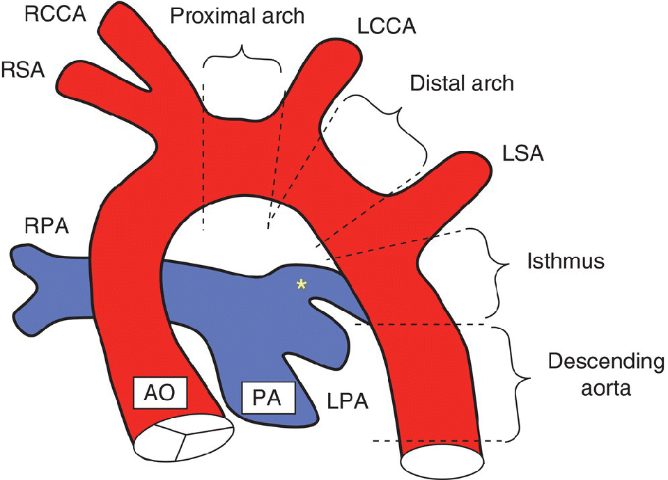 <ul><li><p>ductus arteriosus remains open</p></li><li><p>Located between aortic isthmus and origin of one of the branch pulmonary arteries </p></li><li><p><span style="color: red">Brings <strong>oxygenated blood from aorta to lungs </strong></span></p></li></ul><p></p>