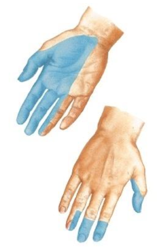 <p><span>What is the cutaneous innervation pattern of the median nerve in the palm?</span></p>