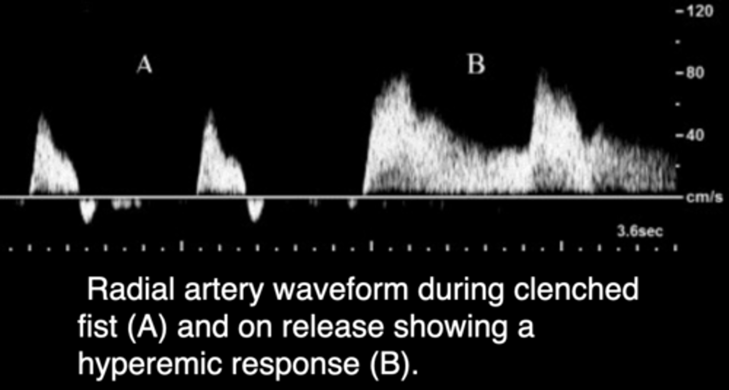 <p>Keep room warm</p><p>Patient in supine/sitting position</p><p>Take bilateral blood pressures</p><p>Take pulses of brachial, radial, and ulnar arteries</p><p>Allen Test: assesses for intact palmar arch - clenched fist - reactive hyperemia after compression indicates patency</p><p>Assess superficial veins using tourniquets</p>