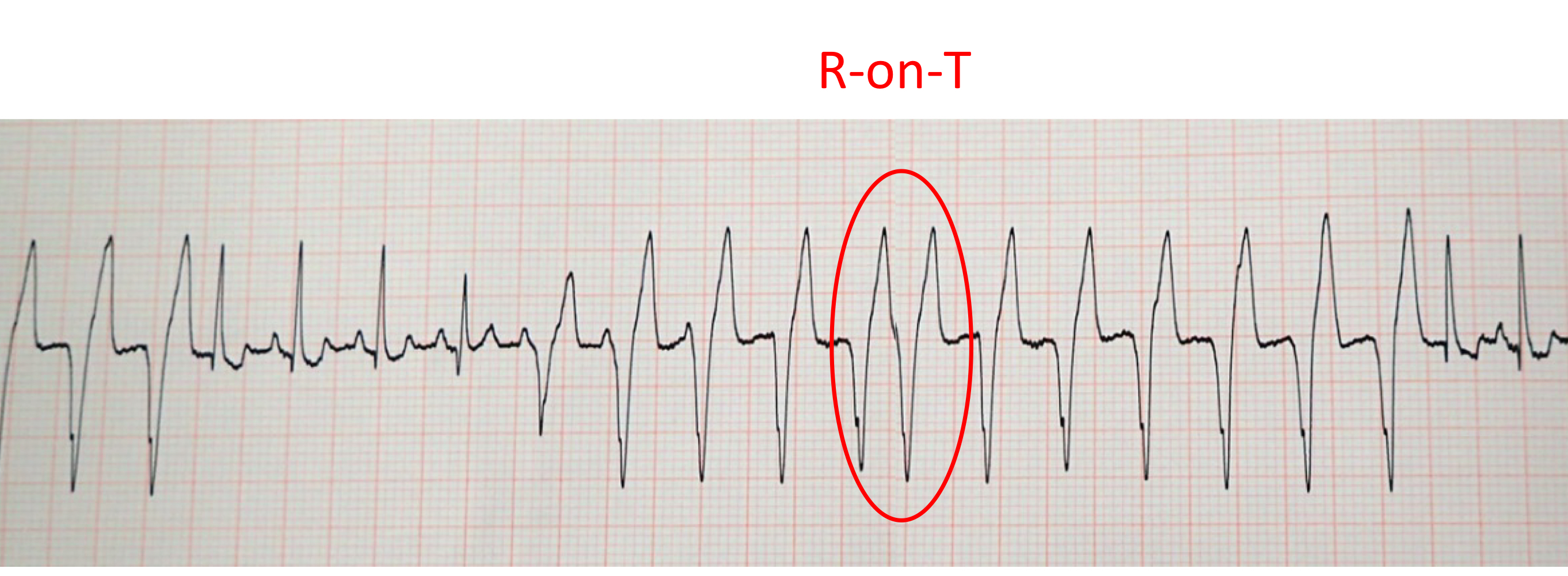 <ol><li><p>symptomatic</p></li><li><p>>160-180 bpm</p></li><li><p>polymorphic/ multiform VPCs</p></li><li><p>R on T phenomenon</p></li></ol><p></p>