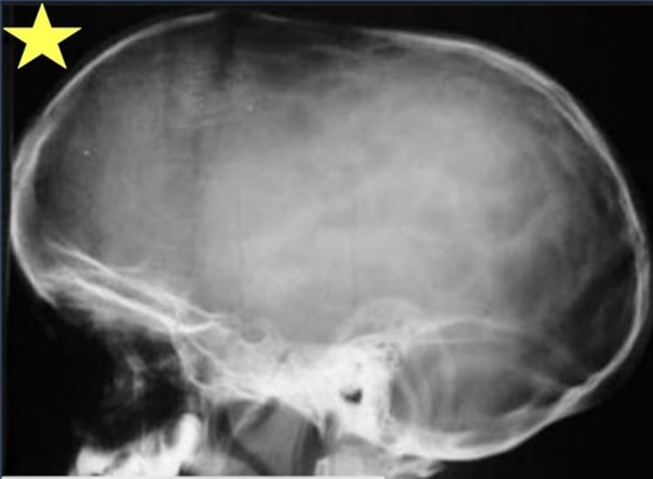 <p>Identify the radiographic abnormality, caused by sagittal craniosynostosis.</p>